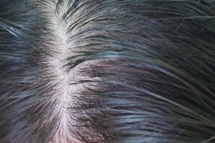 雄激素性脱发头顶油腻脱发图 雄激素性脱发头顶油腻脱发图