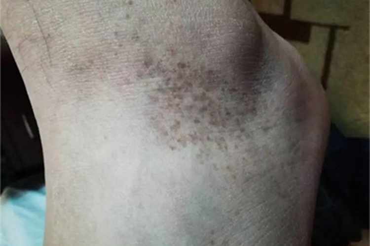 色素性紫癜性皮病脚踝症状图