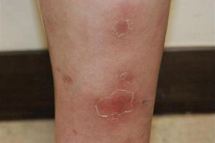 急性期硬化性脂膜炎小腿上红肿图 急性期硬化性脂膜炎小腿上红肿图