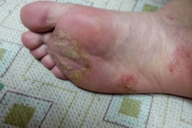 接触传染性脓疱疮脚底黄痂图