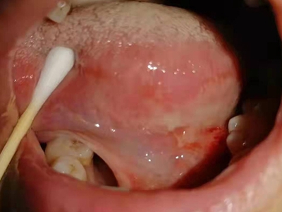 口腔癌舌头下面肿块渗血图