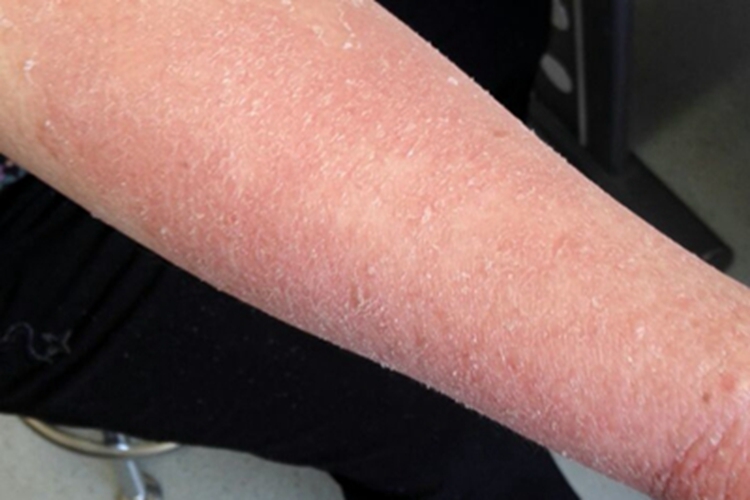 毛发红糠疹性红皮病胳膊脱屑图 毛发红糠疹性红皮病胳膊脱屑图