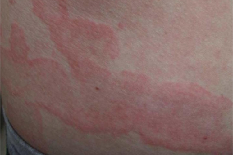 风湿性边缘性红斑背部症状图 风湿性边缘性红斑背部症状图