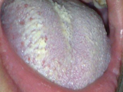 艾滋病期舌头上有毛状白斑图.jpeg
