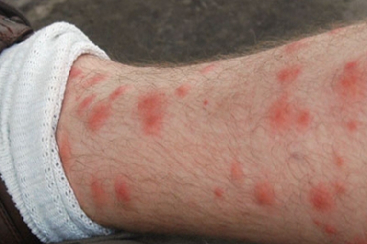螨虫皮炎小腿丘疹图 螨虫皮炎小腿丘疹图