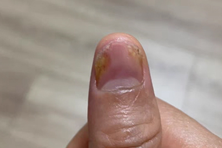 远端侧位甲下型甲真菌病裂纹图
