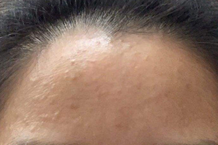 汗管瘤前额肉色丘疹凸起图