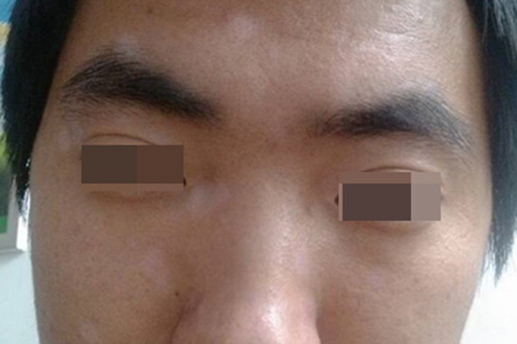 虫斑面部症状图