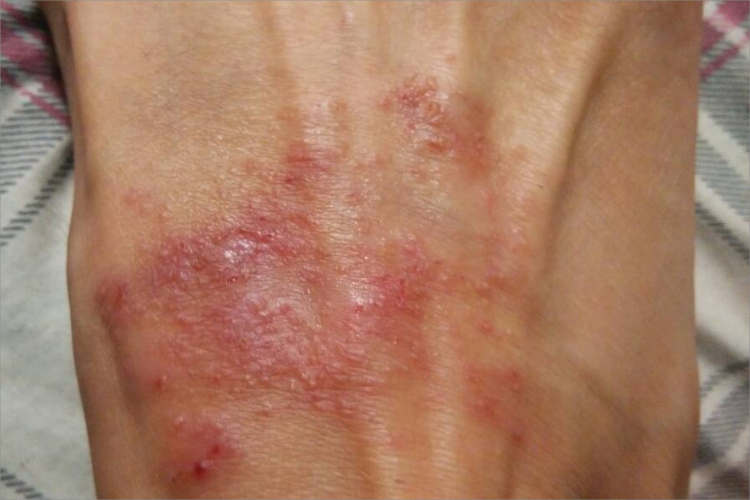 亚急性湿疹小水疱图