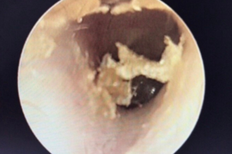 外耳道耵聍栓塞外耳道症状图