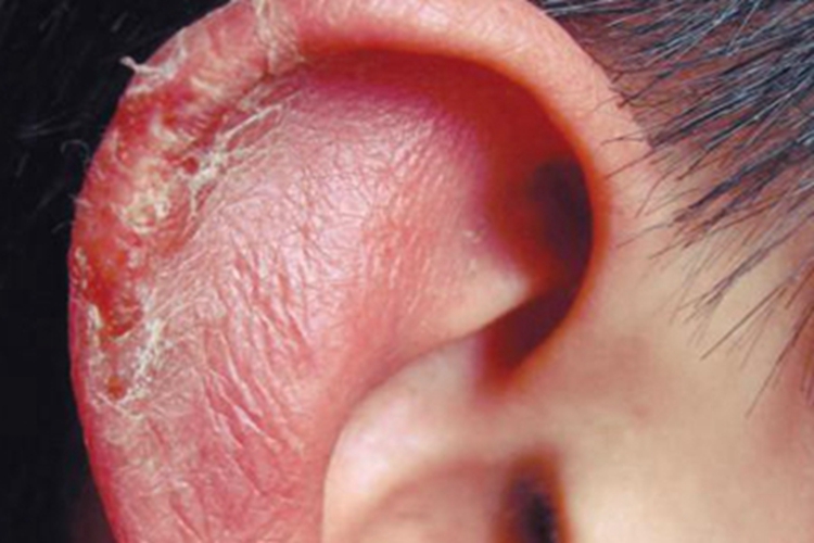 盘状红斑狼疮耳部红斑图