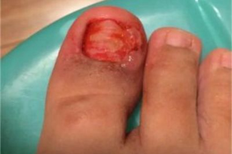 慢性甲沟炎脚趾甲红肿缺损图