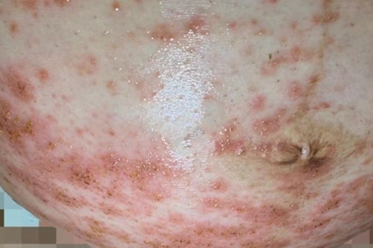 自身敏感性皮炎腹部症状图