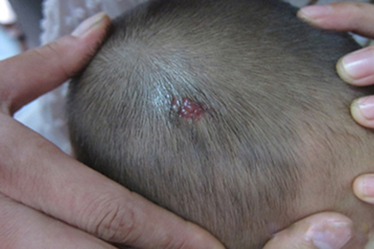 毛细血管瘤头部症状图