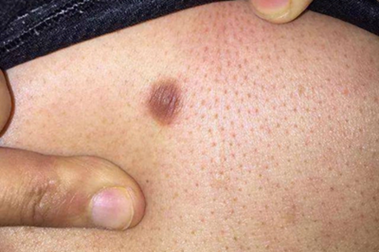 皮肤纤维瘤腹部结节图