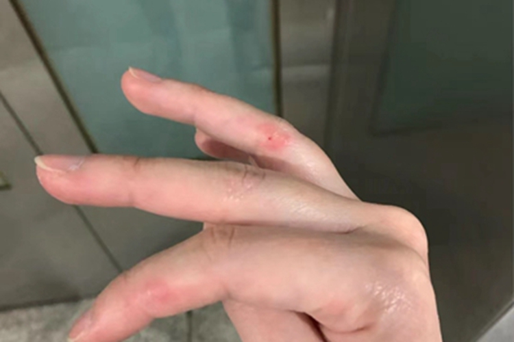 寒冷性多形红斑手部症状图