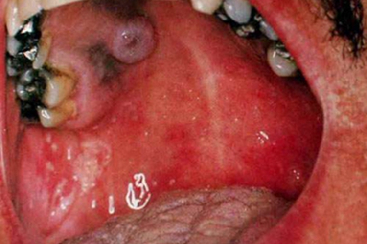 艾滋病口腔卡波西肉瘤图
