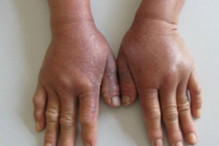 植物-日光性皮炎手背水肿图 植物-日光性皮炎手背水肿图