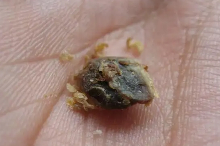 耳朵耵聍团块图 耳朵耵聍团块图