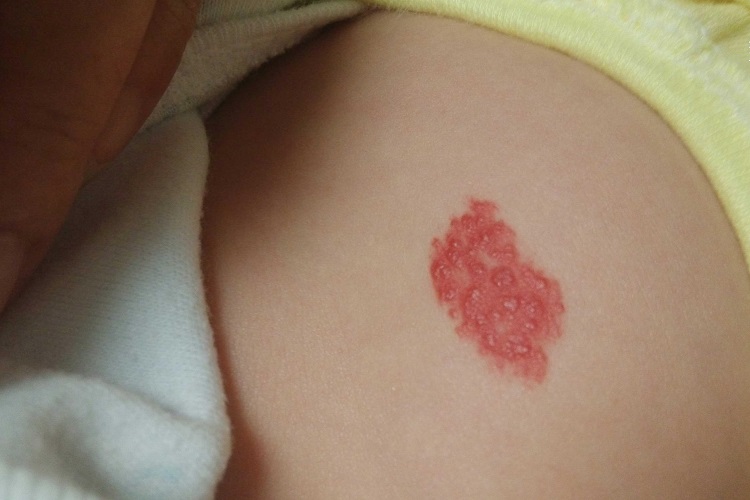 樱桃状血管瘤腰部丘疹图 樱桃状血管瘤腰部丘疹图