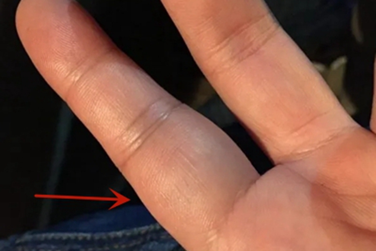 轻度扭伤手部症状图