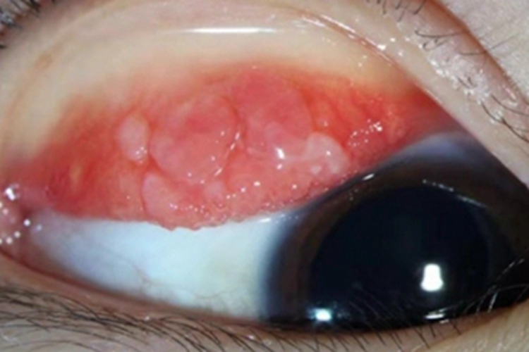 巨乳头性结膜炎内眼睑起疙瘩图