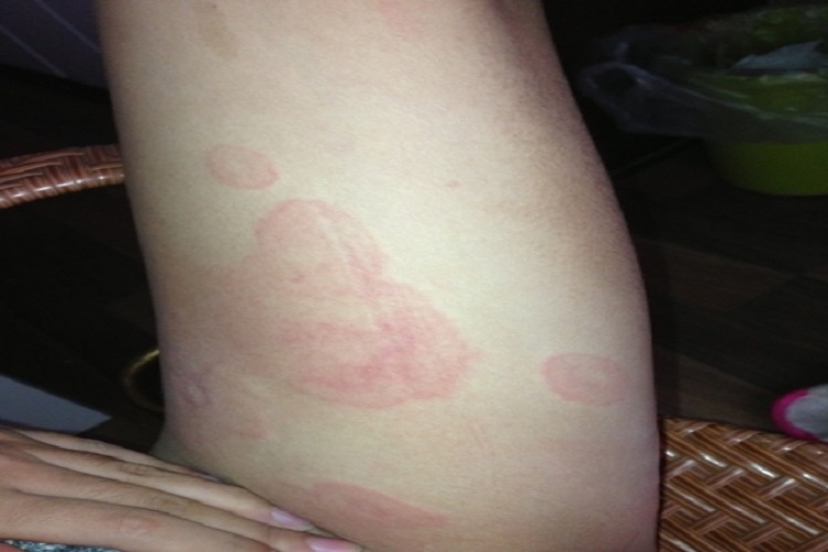 大腿根部内侧荨麻疹图