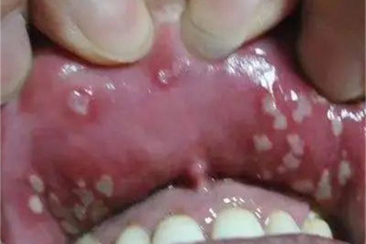 疱疹样阿弗他溃疡唇内侧白点图