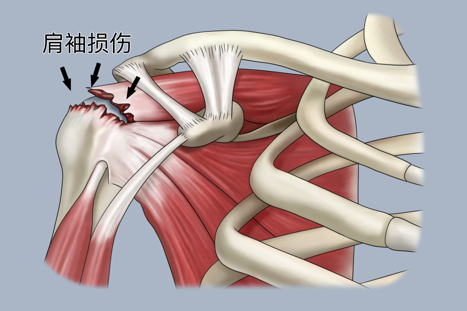 肩袖损伤解剖图