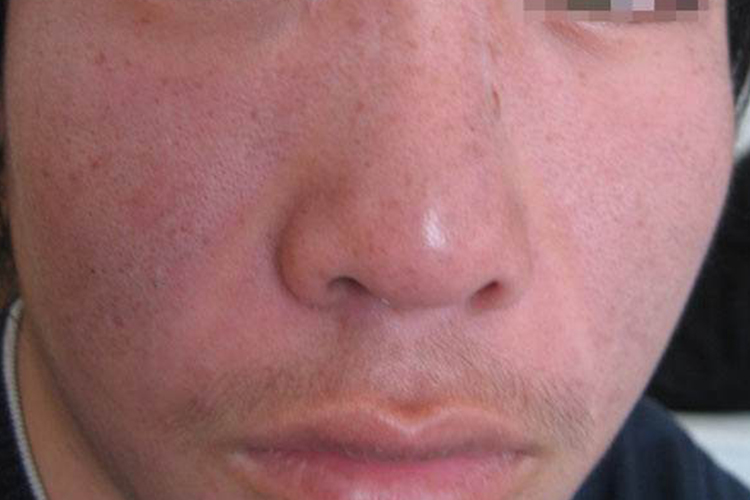 皮肌炎醉酒样面容图