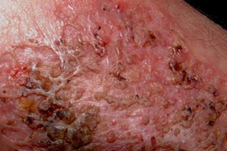 芽生菌病样脓皮病胳膊肿块图