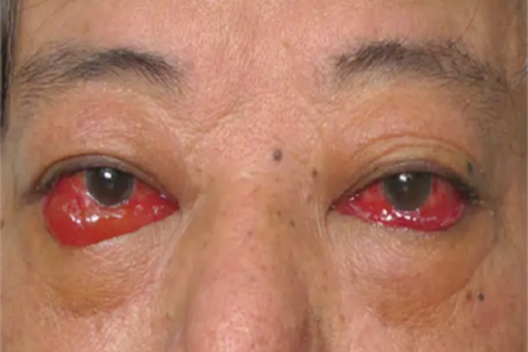 甲状腺相关眼病眼睑变形图 甲状腺相关眼病眼睑变形图