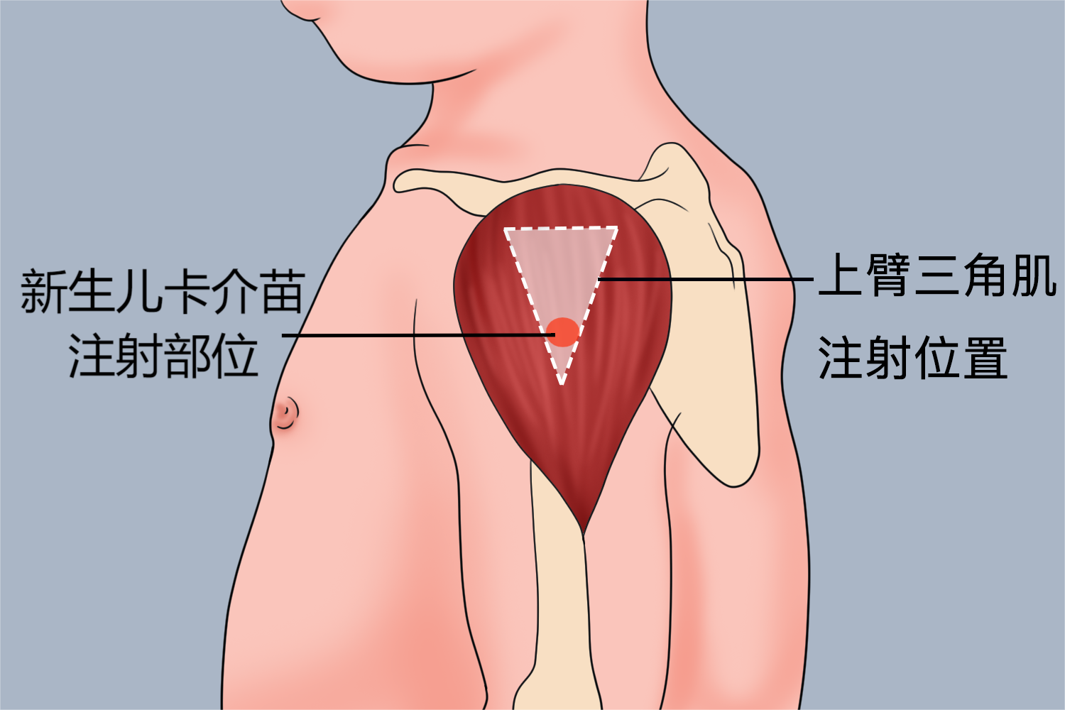 新生儿卡介苗注射部位图 新生儿卡介苗注射部位图
