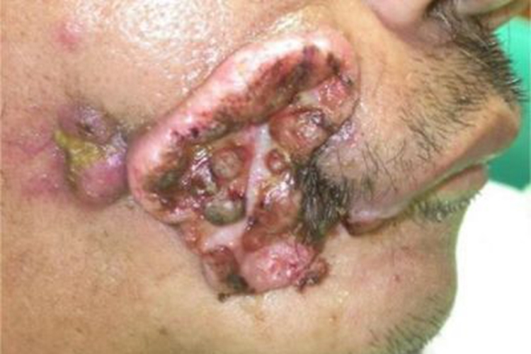 颊癌脸部大片溃疡结痂图 颊癌脸部大片溃疡结痂图
