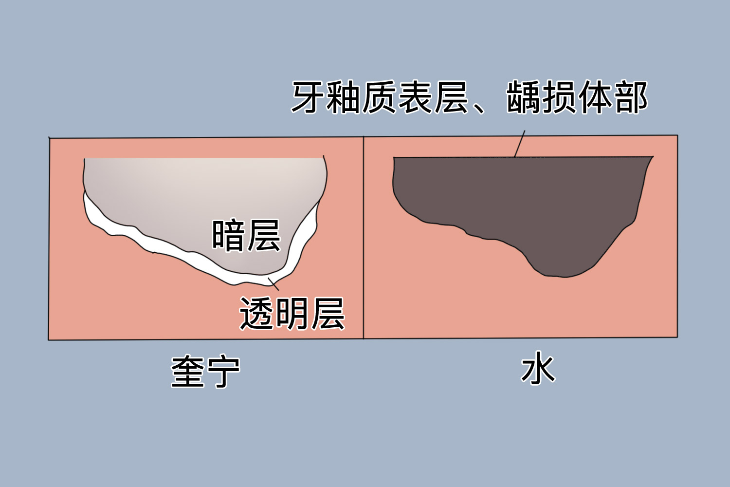 牙釉质龋分层示意图 牙釉质龋分层示意图