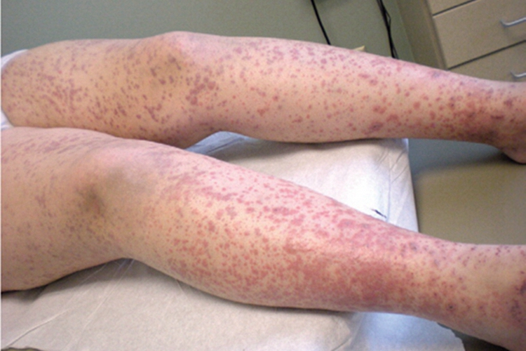 小儿过敏性紫癜小腿红色斑点图