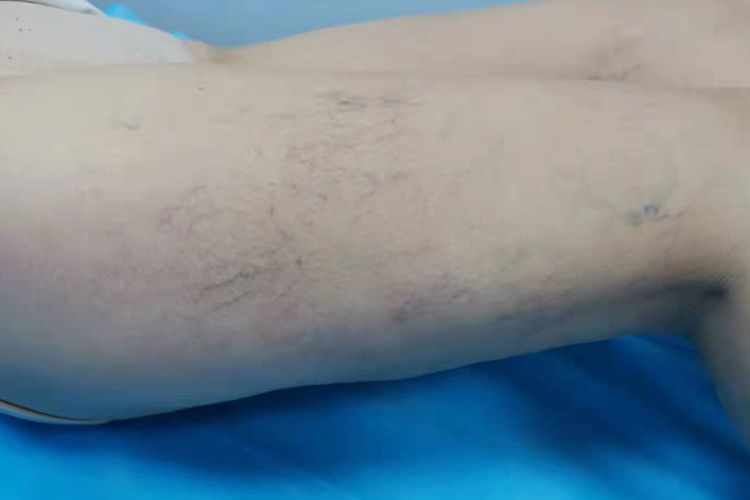 一级静脉曲张图