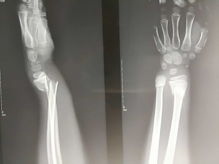 尺桡骨远端骨折X线图 尺桡骨远端骨折X线图