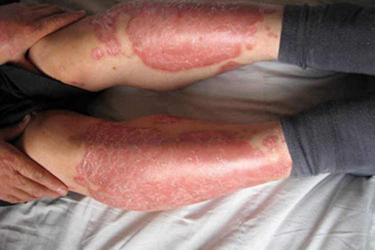 增殖性皮炎小腿症状图 增殖性皮炎小腿症状图