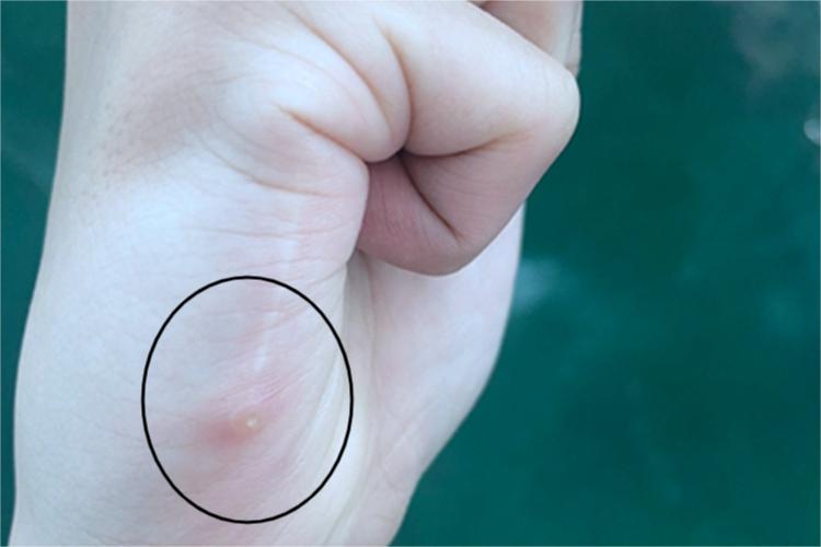 成人痒疹手掌疙瘩图 成人痒疹手掌疙瘩图