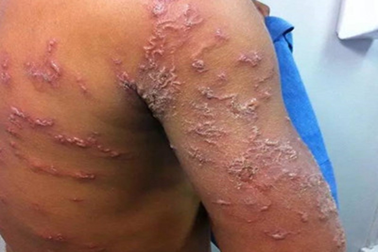 皮肤幼虫移行症胳膊脱皮图