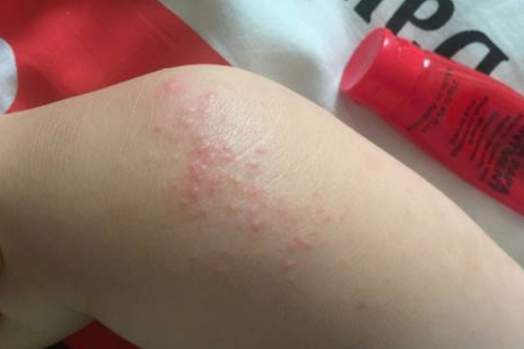 孩子10岁接触性皮炎图