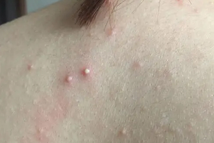 痤疮背部症状图