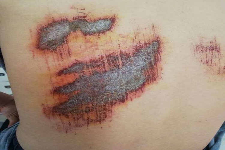 背上擦伤伤口图