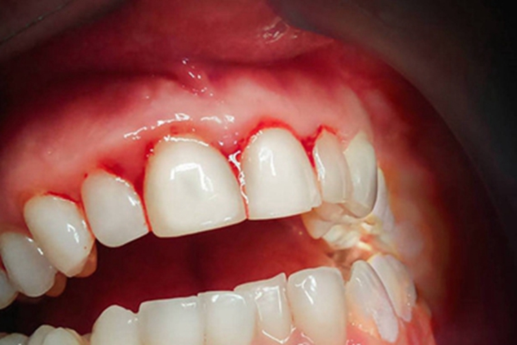 登革热牙龈红肿出血图