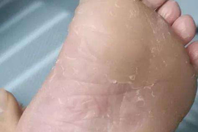 弥漫性掌跖角化病脚底脱屑图