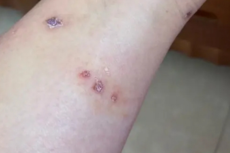 蠓虫叮咬引起的皮肤反应结痂图