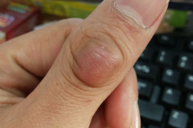 大拇指皮脂腺囊肿图