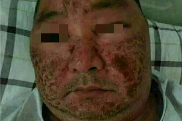 浅Ⅱ度烧伤发红图