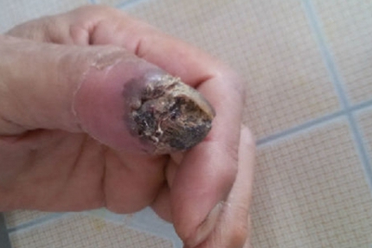 肢端雀斑痣样黑素瘤手指甲糜烂图